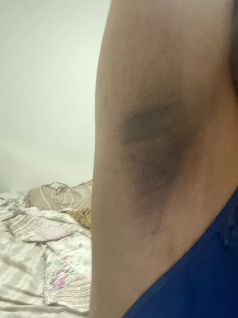 Axila com manchas escuras antes do Sérum Clareador Maxfem