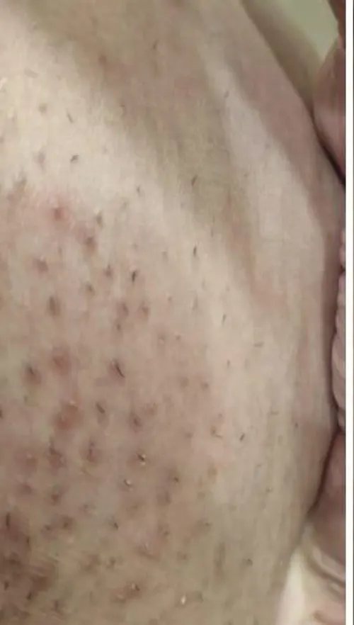 Virilha com foliculite e manchas antes do Sérum Clareador Maxfem