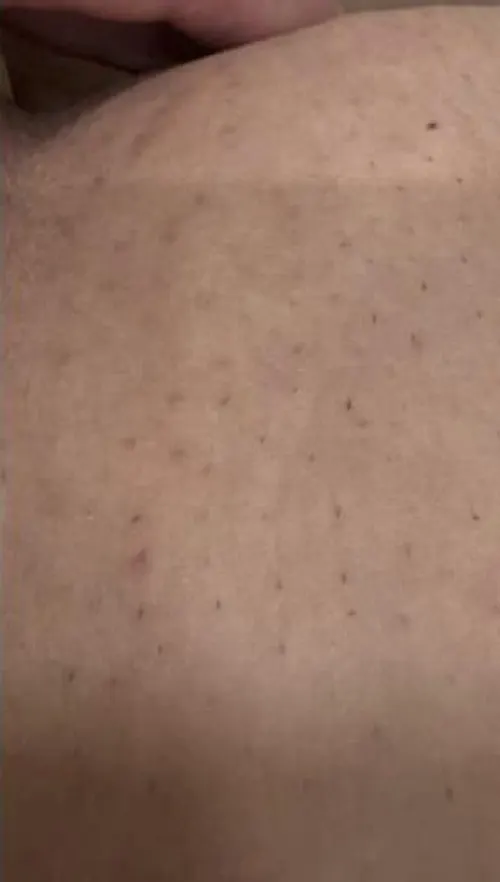 Virilha uniformizada e mais limpa depois do Sérum Clareador Maxfem